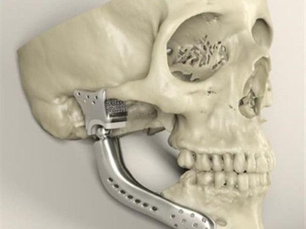 簡(jiǎn)述3D打印技術(shù)在醫(yī)療行業(yè)應(yīng)用情況_e鍵3D打印服務(wù) 簡(jiǎn)述3D打印技術(shù)在醫(yī)療行業(yè)應(yīng)用情況_e鍵3D打印服務(wù)