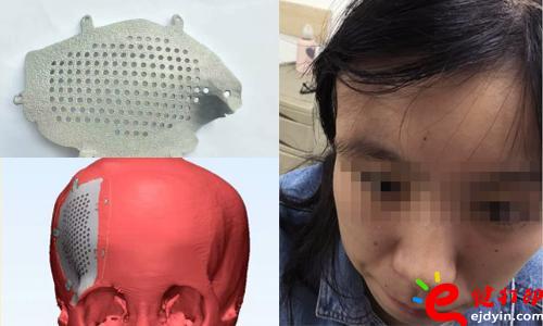 醫療3d打印應用,醫用3d打印,3D打印假肢,3D打印脊椎,3D打印心臟,e鍵打印,3d打印服務 3D打印的顱骨假體,非常適用于發際外的顱骨缺損、病變置換,將使患者的面容恢復到正常形態,完美解決了傳統顱骨修補存在的美容問題。據悉,3D打印個性化顱骨假體修補技術已獲國家重點研發計劃資助,能為一批病人免費提供假體,并能減免一些檢查和治療費用。未來將實行72小時的3D假體個性化顱骨修補術,造福更多的患者。 醫療3d打印應用,醫用3d打印,3D打印假肢,3D打印脊椎,3D打印心臟,e鍵打印,3d打印服務 3D打印的顱骨假體,非常適用于發際外的顱骨缺損、病變置換,將使患者的面容恢復到正常形態,完美解決了傳統顱骨修補存在的美容問題。據悉,3D打印個性化顱骨假體修補技術已獲國家重點研發計劃資助,能為一批病人免費提供假體,并能減免一些檢查和治療費用。未來將實行72小時的3D假體個性化顱骨修補術,造福更多的患者。